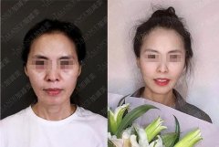 面部整形一个月费用多少钱(面部整形大约费用)