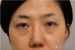 眼袋整形价格要多少(眼袋整形费用一般是多少钱)