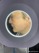 激光整形多少钱(激光美容多少钱)