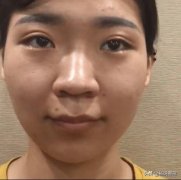 缩鼻翼手术整形多少钱(做缩小鼻翼手术是多少钱)