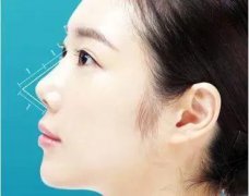 鼻子缩短整形手术多少钱(鼻子拉长手术多少钱)
