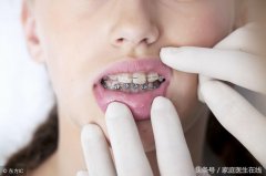 多少岁可以牙齿整形(多少岁能整牙)