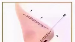 整形子多少钱(整形子多少钱一次)