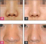 整形缩小鼻子要多少久时间(缩小鼻子手术能维持多久)