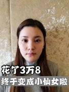 郑州隆鼻多少钱到集美整形(郑州隆鼻多少钱到集美整形医院)