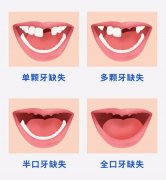 广州龅牙整形多少钱(龅牙齿整形多少钱)