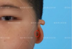 小耳整形要多少钱(小耳朵整形大概多少钱)