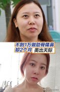 软骨鼻尖整形多少钱(软骨隆鼻术多少钱)