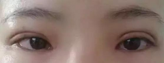眼皮凹塔整形多少费用(凹陷眼割双眼皮图片)