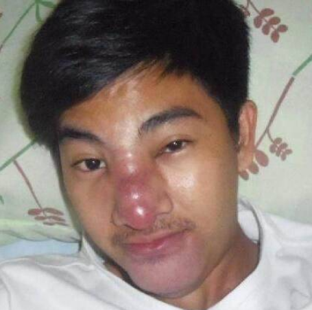 小伙花费70元整容，结果整容失败致脸部溃烂，帅小伙变成丑男