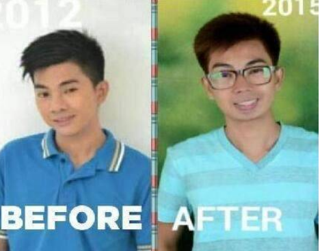 小伙花费70元整容，结果整容失败致脸部溃烂，帅小伙变成丑男