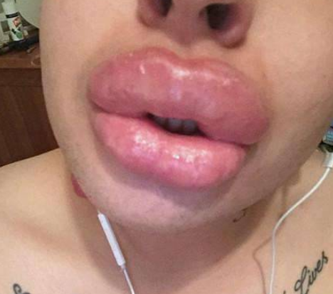 男子为了追星，花费100万整容50次，如今嘴巴变“香肠嘴