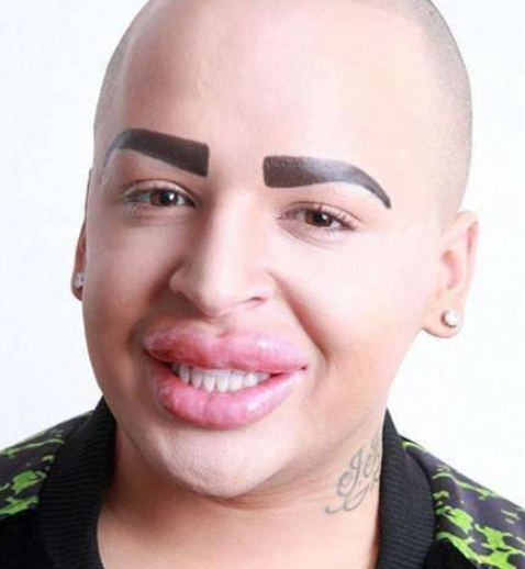 男子为了追星，花费100万整容50次，如今嘴巴变“香肠嘴