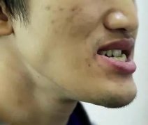 20岁地包天整形多少钱(地包天20岁矫正多少钱)